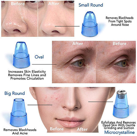 DermaSuction Blackhead & Dirt Remover