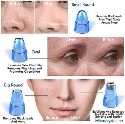 DermaSuction Blackhead & Dirt Remover